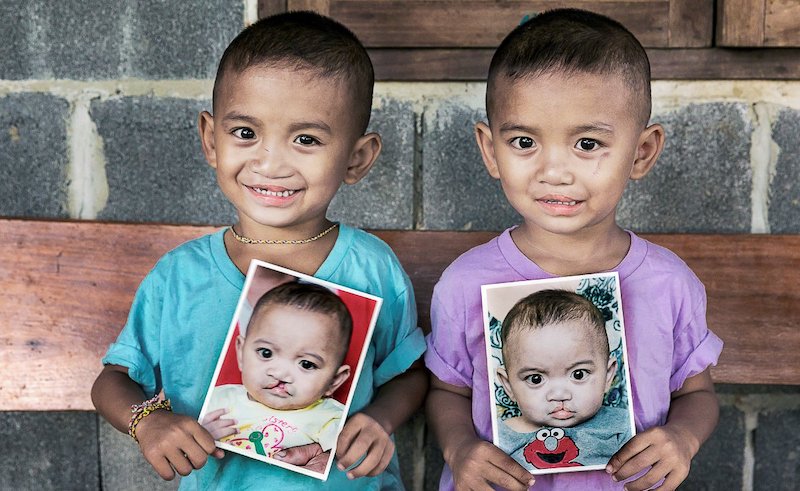 Operation Smile Hosts Free Convoy in Aswan to Help Treat Cleft Lip