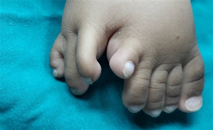 A Team of Egyptian Doctors Perform Surgery on a Baby’s Third Foot